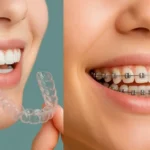Clear aligner and metal braces shown side by side for comparison